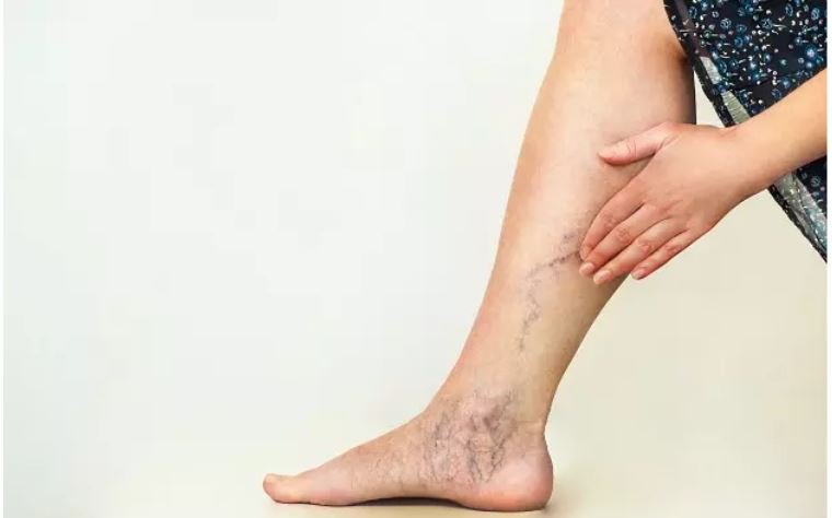 varicose veins